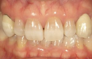 変色した歯を白く、詰め物跡をきれいにするラミネートベニア法とは？
