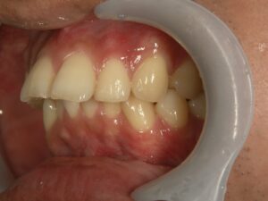 出っ歯治療