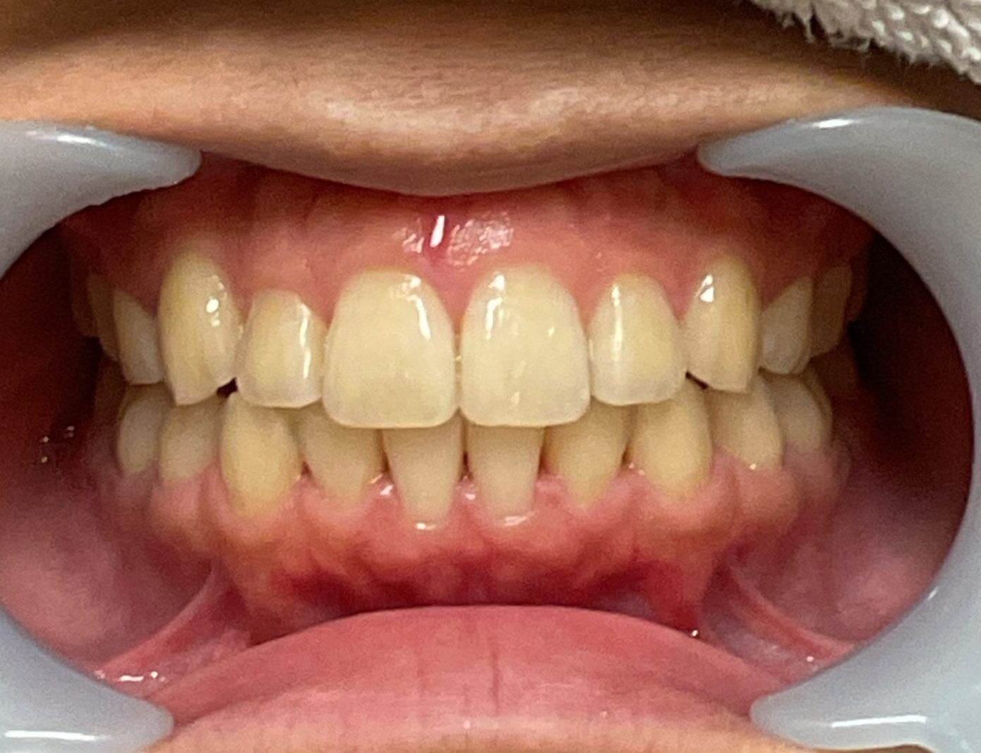 形態修正 前歯のギザギザ