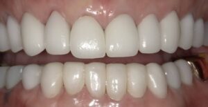 前歯　根本が黒い　古い差し歯　金属