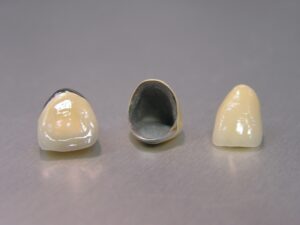 差し歯　根元　黒ずみ セラミック　比較