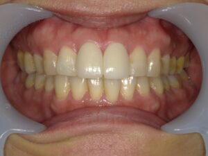 前歯　セラミック　黒ずみ